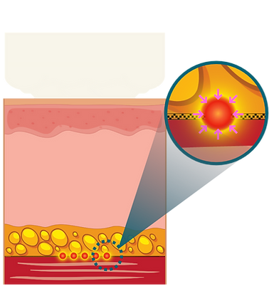 Immediate contraction and tightening of the SMAS layer follow